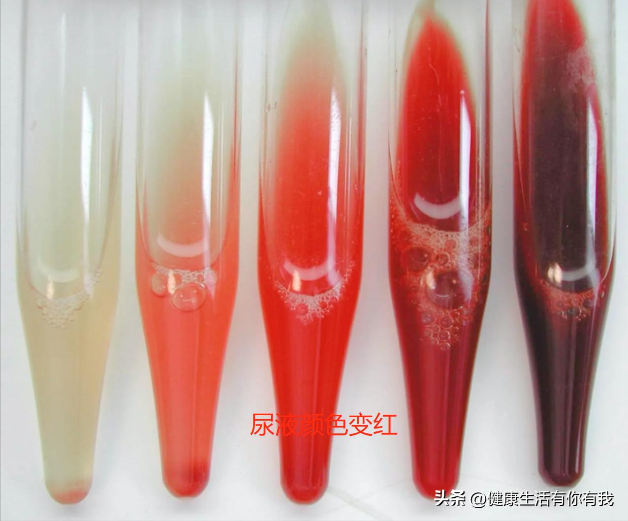 什么是血尿和尿潜血,什么是血尿是怎么回事