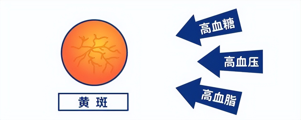 怎么预防老年黄斑病变,什么是黄斑变性怎样预防和治疗