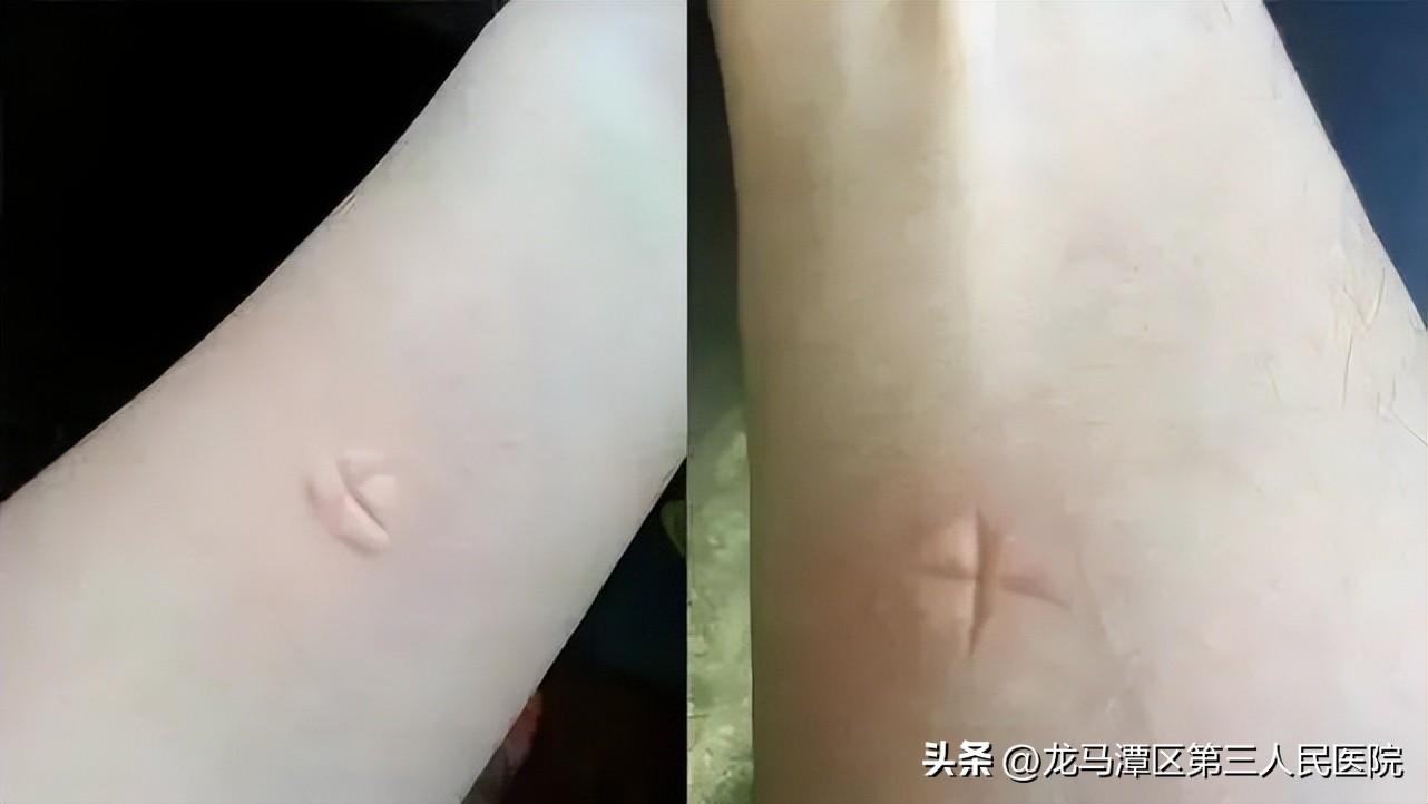 蚊虫叮咬后反复痒和红肿怎么办,海南蚊虫叮咬红肿痒怎么办