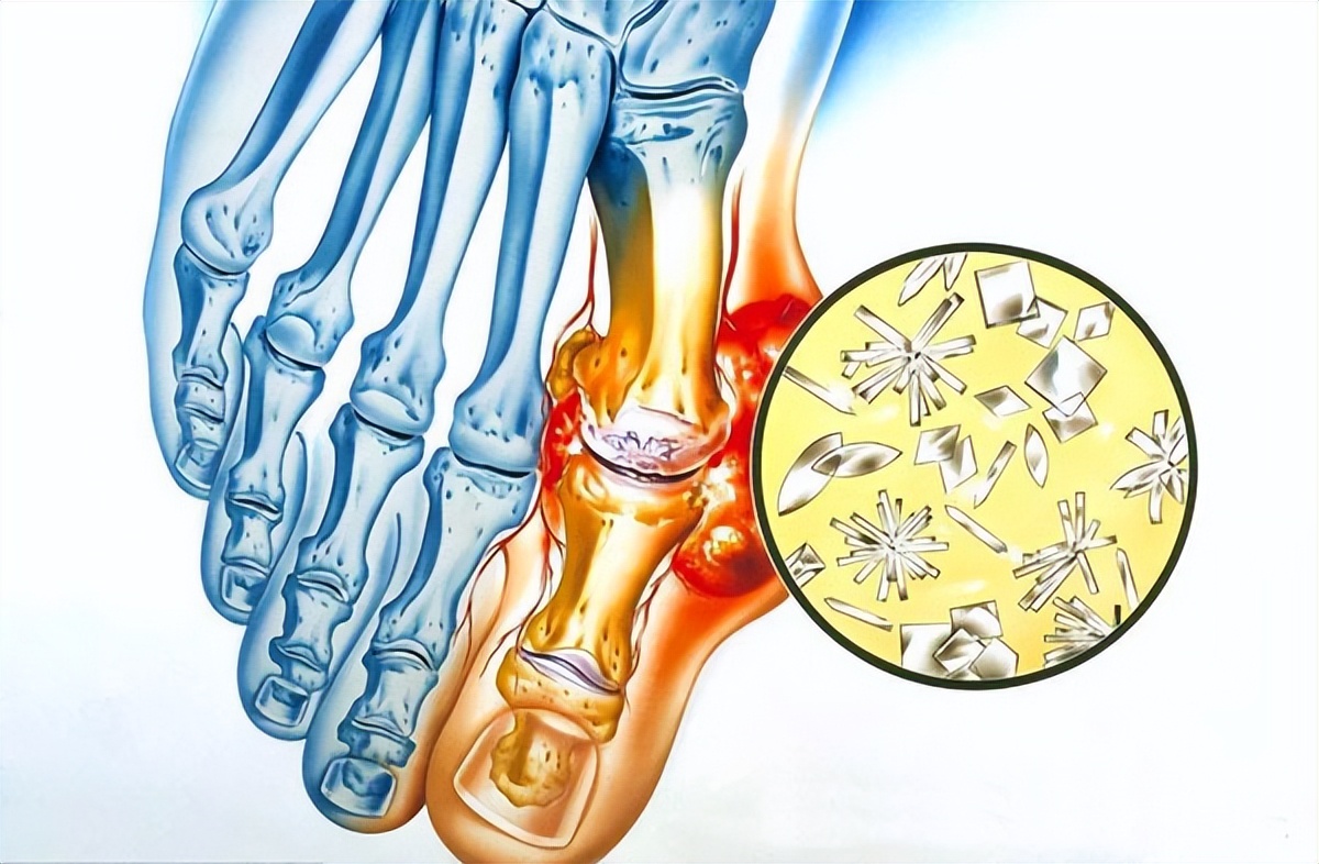 男子痛风血尿查出肾衰，吃3种食物容易尿酸高，中医治疗尿酸肾病