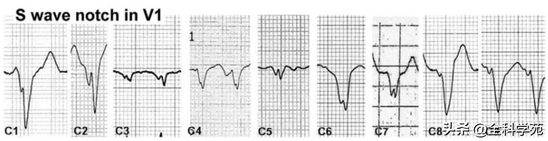 心电图上表现为宽qrs波,心电图中qrs是代表心动过速吗
