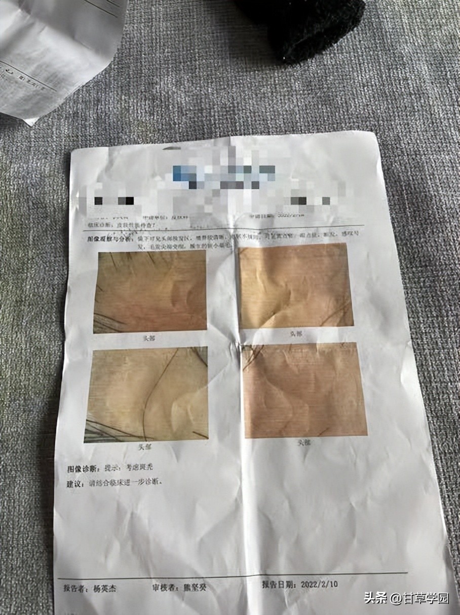 复方甘草治疗斑秃,甘草煮水治疗斑秃效果好吗