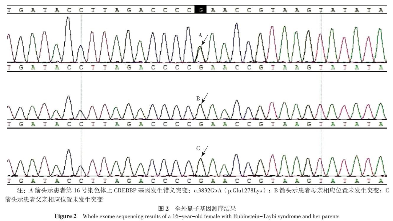 鲁宾斯坦泰比综合征的治疗方法,鲁宾斯坦泰比综合征是罕见病吗