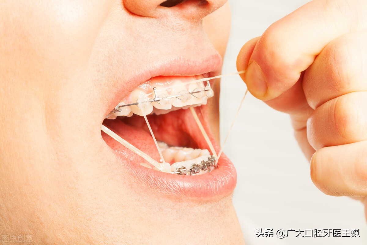 牙齿黑三角治疗最好的方法,牙齿黑三角怎么修复最简单方法