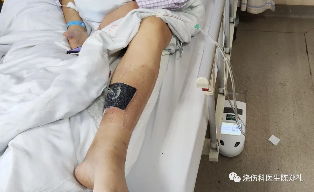 创面外用药物及敷料的使用策略及理论依据