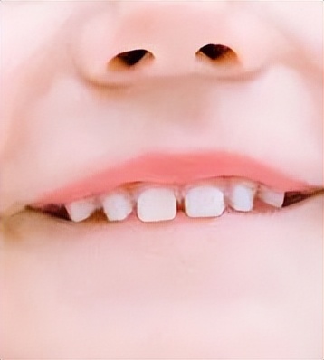 宝宝牙缝大是吃糖引起的吗,宝宝牙缝太宽了吧