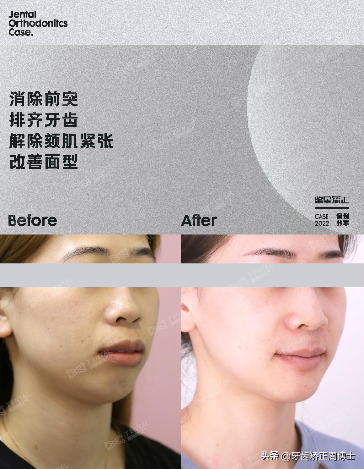 骨性前突正畸后多长时间有效果,牙性下巴后缩可以戴牙套改善吗