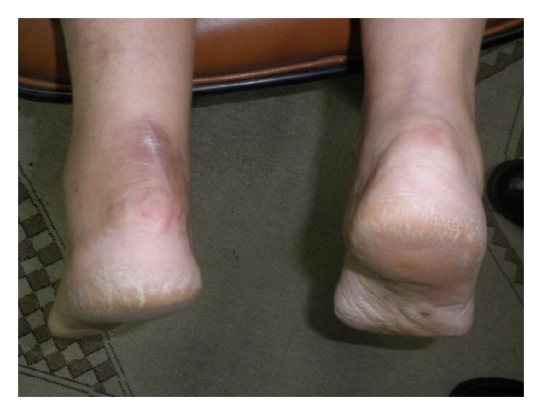 什么动作可以缓解走路足跟痛,经常走路脚疼如何减轻