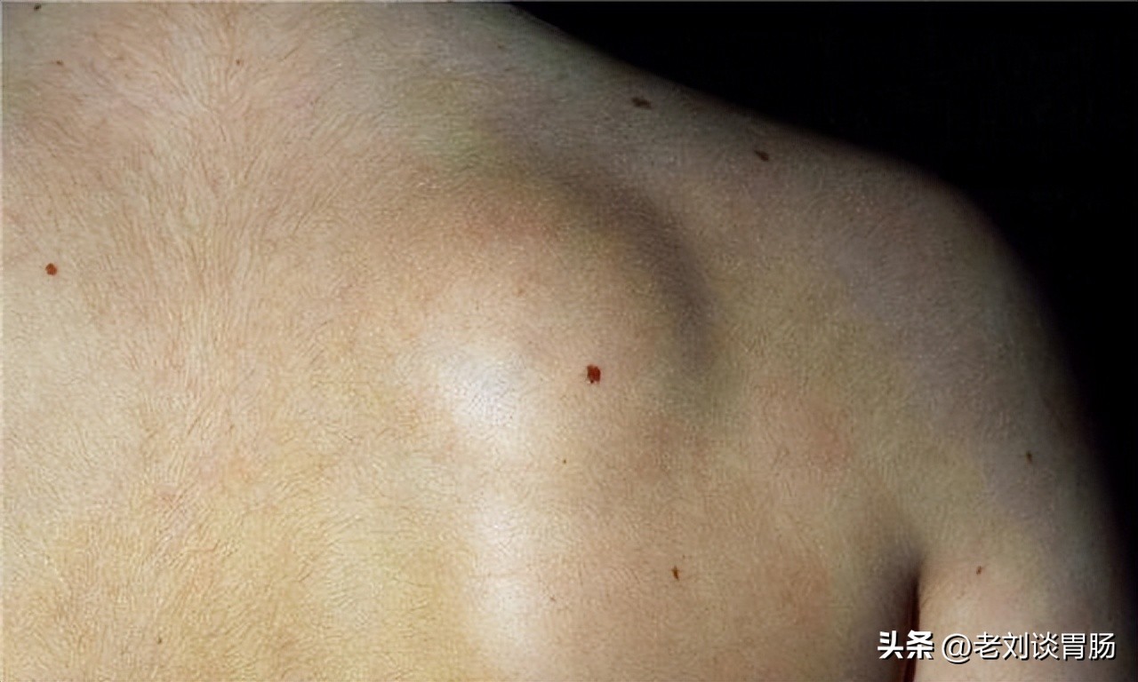 身体表面长了小肉疙瘩是什么病,身体表皮长肉疙瘩图片