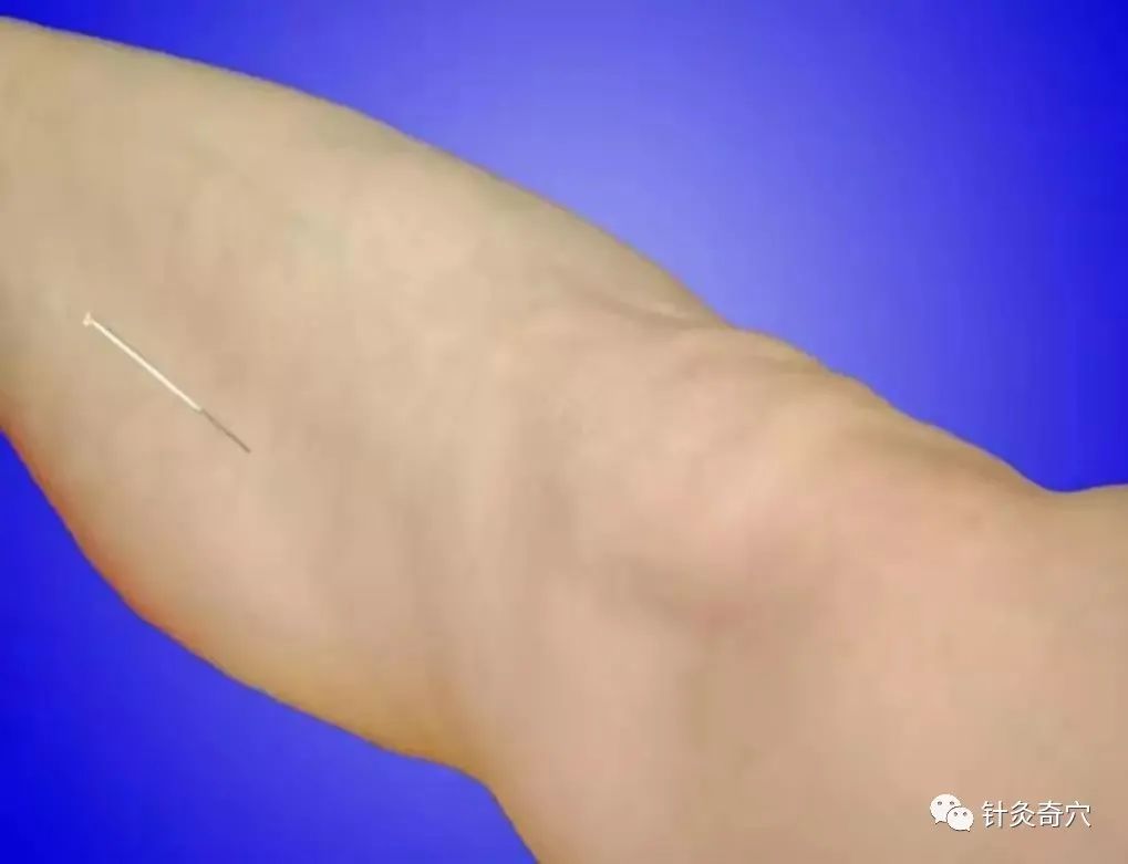 史上最全中医针灸视频教程全集,针灸治疗真实图片大全