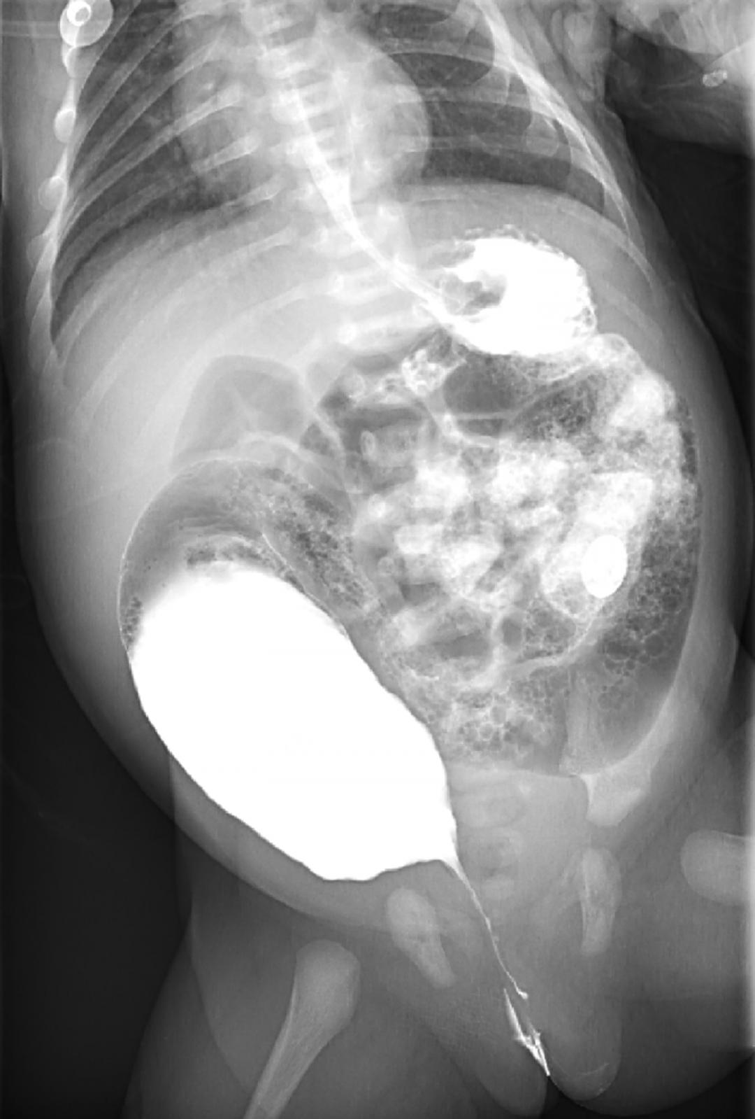 30天的小孩子肚子鼓鼓的硬硬的,儿童肚子胀得像大气球