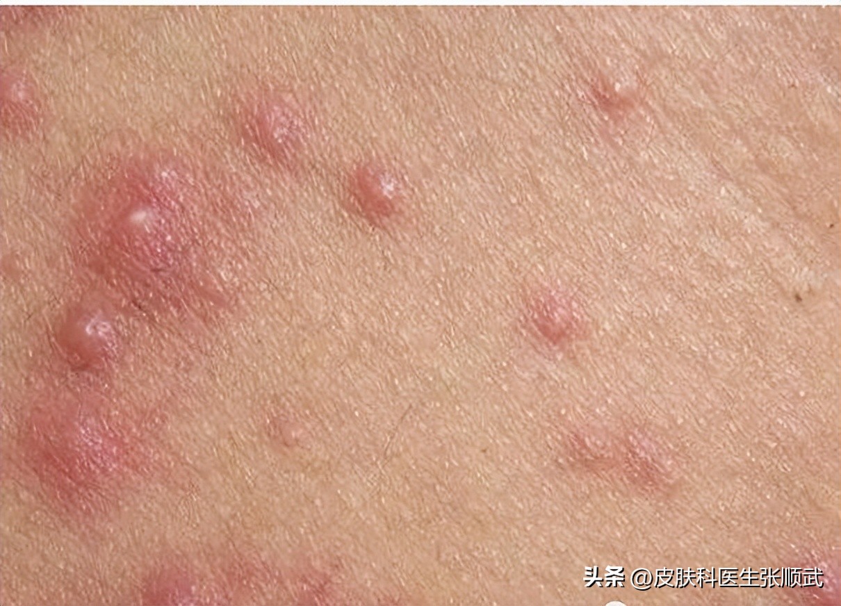 螨虫毛囊炎用什么药物治疗,毛囊炎用什么药治疗最好