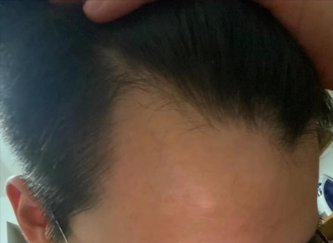 男生发际线秃适合剪什么头发,男生发量少发际线高适合什么烫发