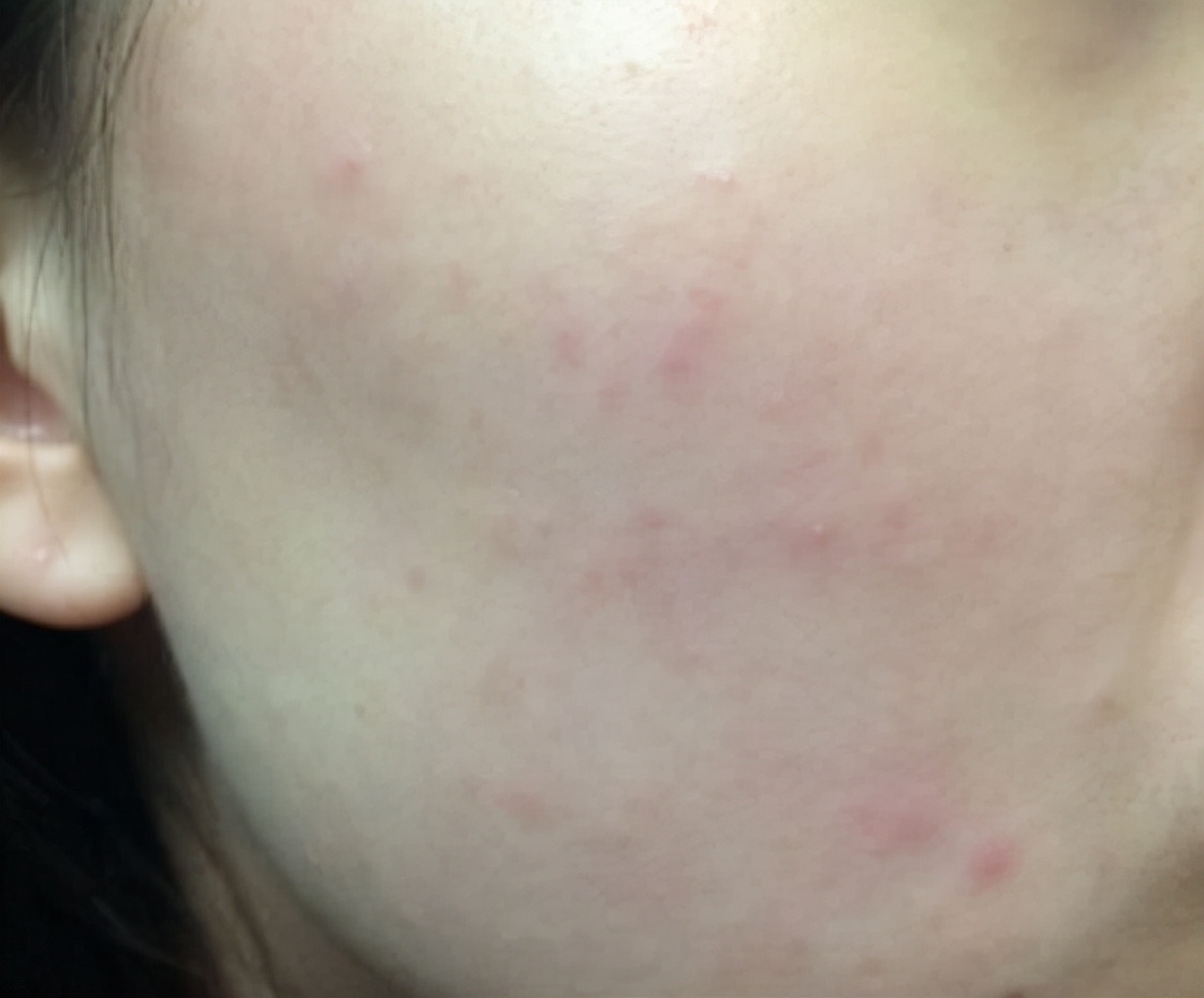 用了化妆品后脸上起白色小疹子,用了护肤品后脸上出现小疙瘩还痒