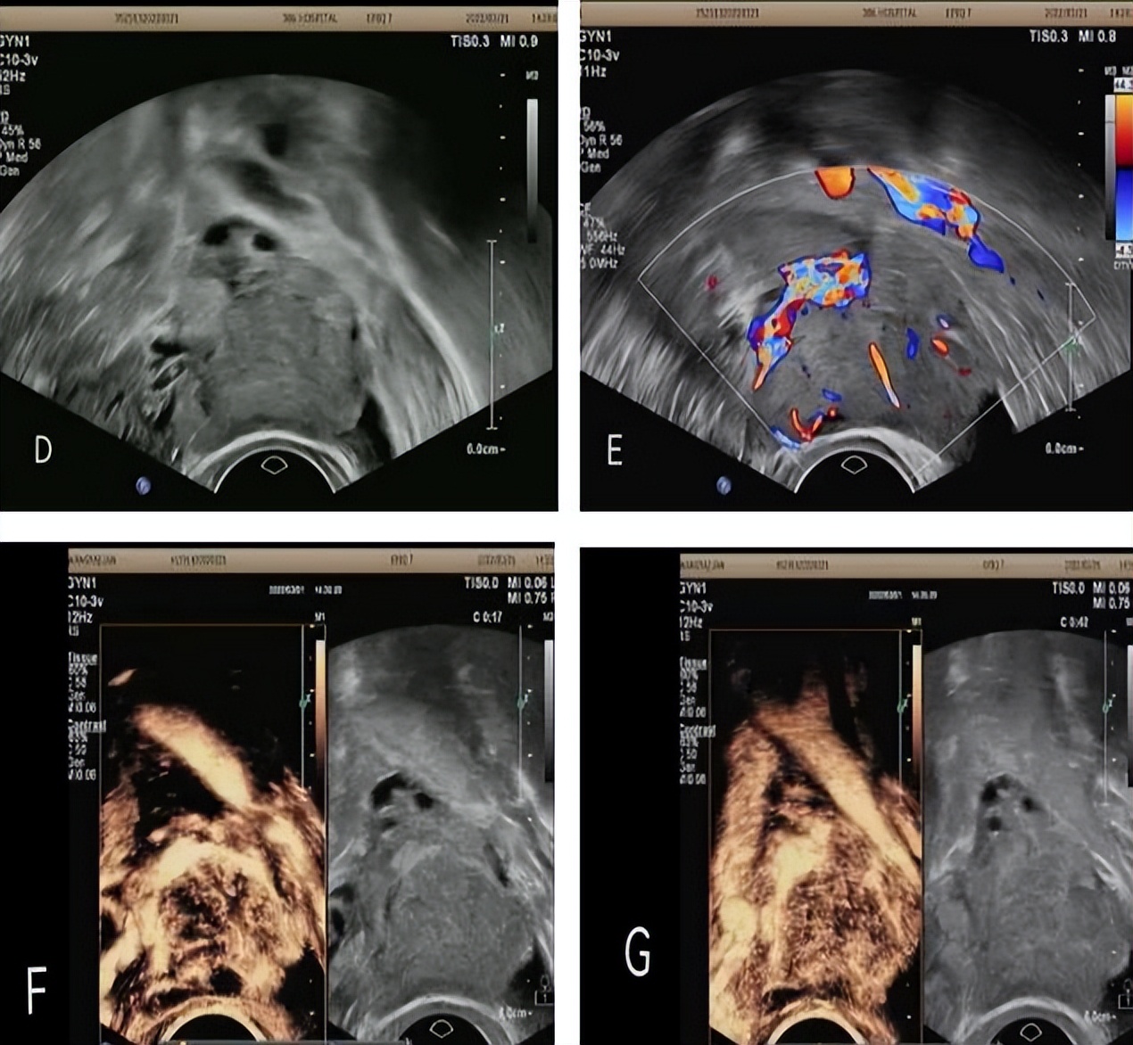 超声静脉造影剂注射操作视频,超声静脉自显影