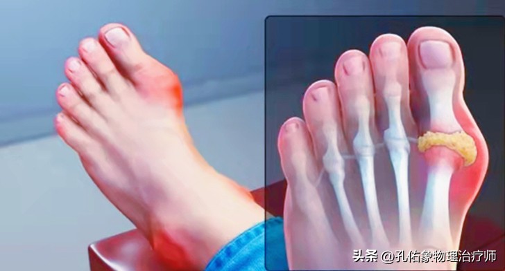 痛风患者哪些豆类不能吃,我国超千万人患痛风祸根