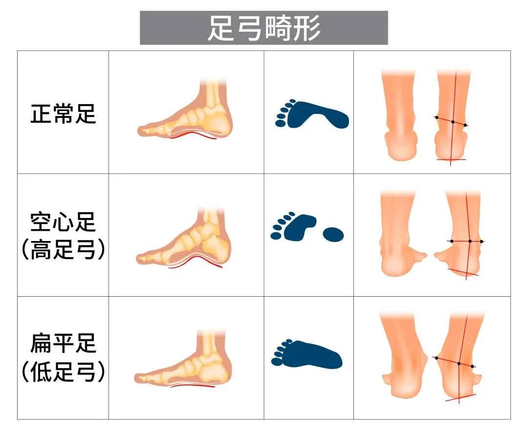 鞋子磨脚怎么办教你如何轻松解决,鞋子太紧磨脚
