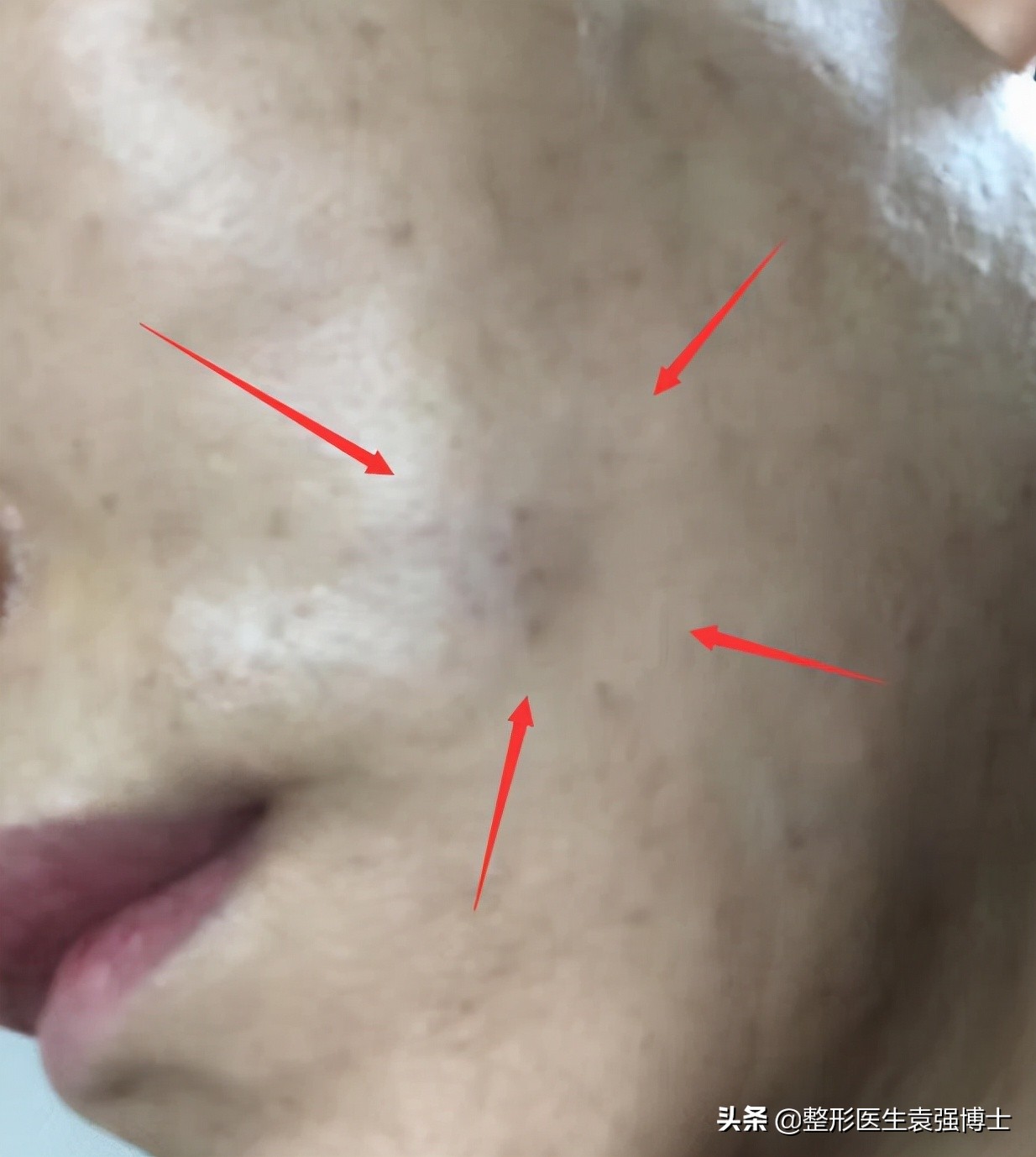 做完线雕不戴头套感觉撕拉痛,做完线雕为什么不能嚼硬东西