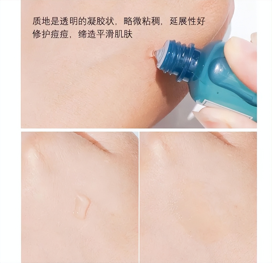 石原里美、Chloe都在用的祛痘、祛痘印方法 你不想知道吗？