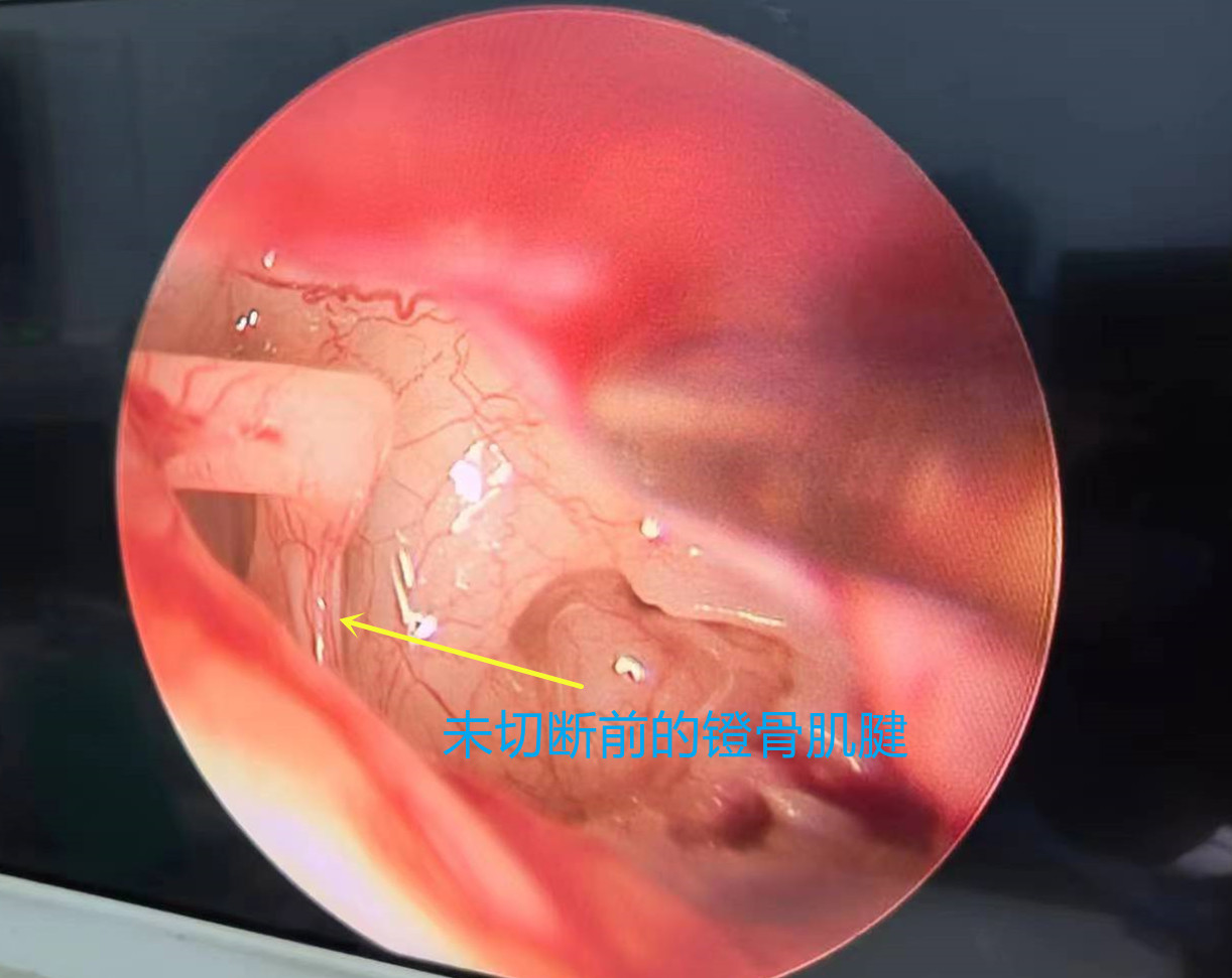 面肌痉挛耳后微创治疗,面肌痉挛外科微创诊治副作用