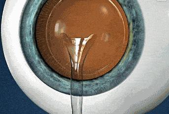 角膜白斑能做近视晶体植入吗,角膜薄近视手术晶体植入