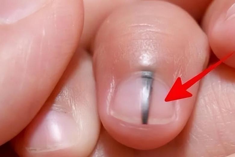 小脚趾甲分成两瓣的人怎么了,小脚趾甲长成两瓣