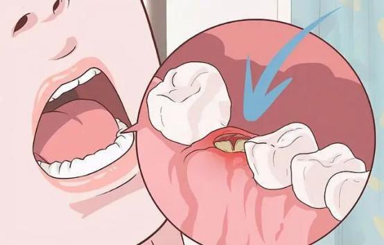 拔完牙慢慢的吐口水可以吗,拔完牙十个小时吐了口口水