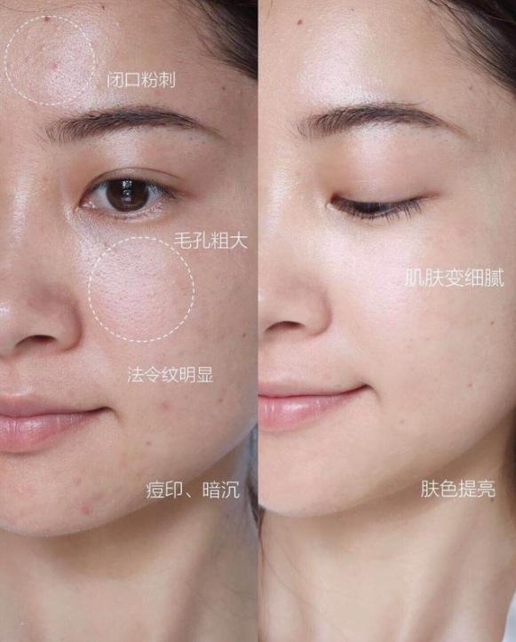 用完爽肤水洗脸的正确方法,每天清水洗脸后擦爽肤水可以吗