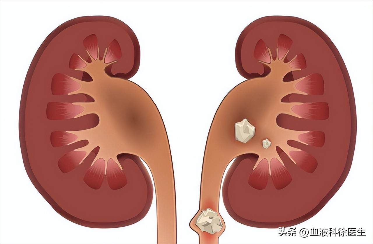 体检出肾结石怎么去医院问诊,体检检查出肾结石怎么处理