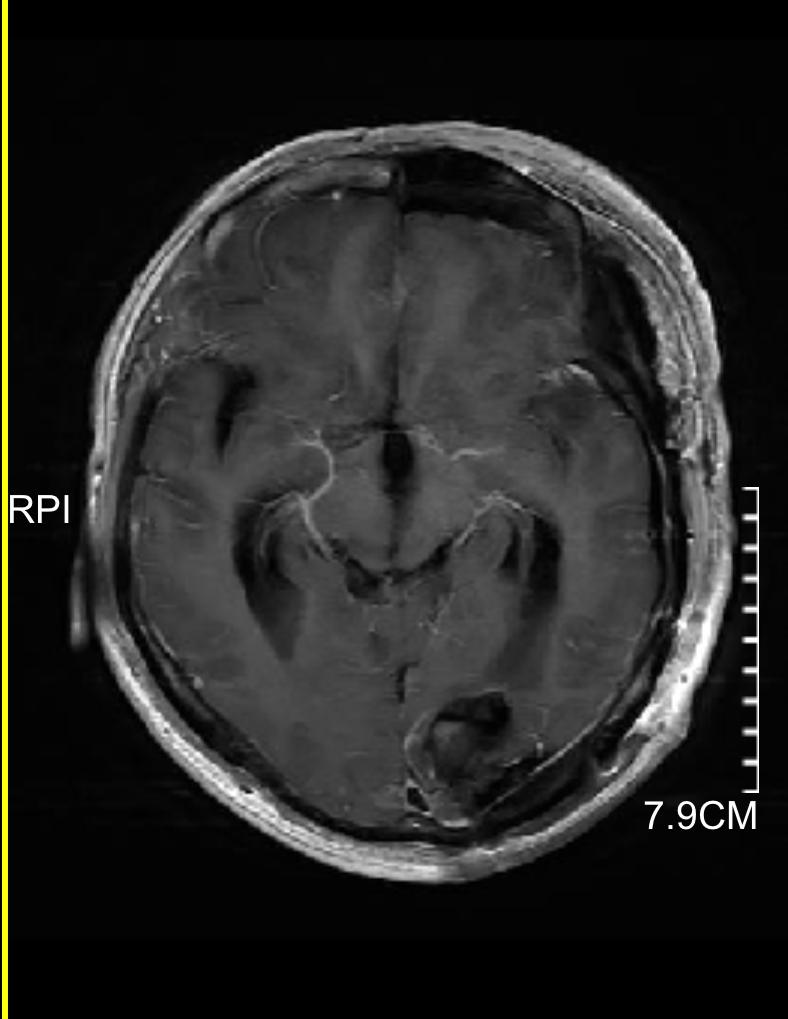 发现脑肿瘤怎么办,发现脑卒中前兆怎么办