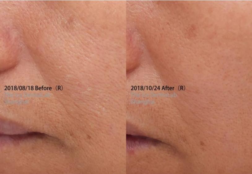 消除法令纹的正确方法是什么呢,有法令纹怎么办简单又实用的方法