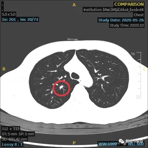 炎症引起的肺实性结节生长速度,肺部结节影像学读片讲解视频