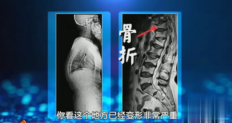 脊柱病三个动作自愈方法,椎间盘突出可以做脊柱屈的动作吗