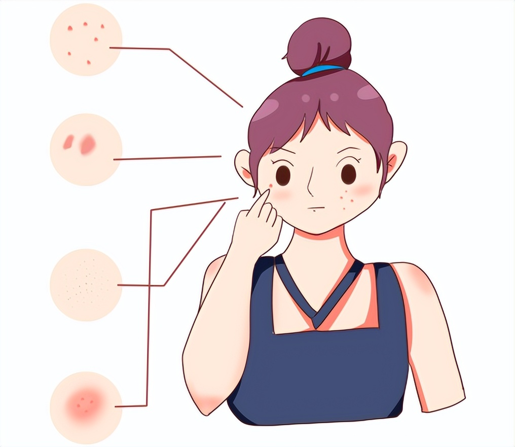 夏日要预防日光性皮炎,日光性皮炎夏天如何预防