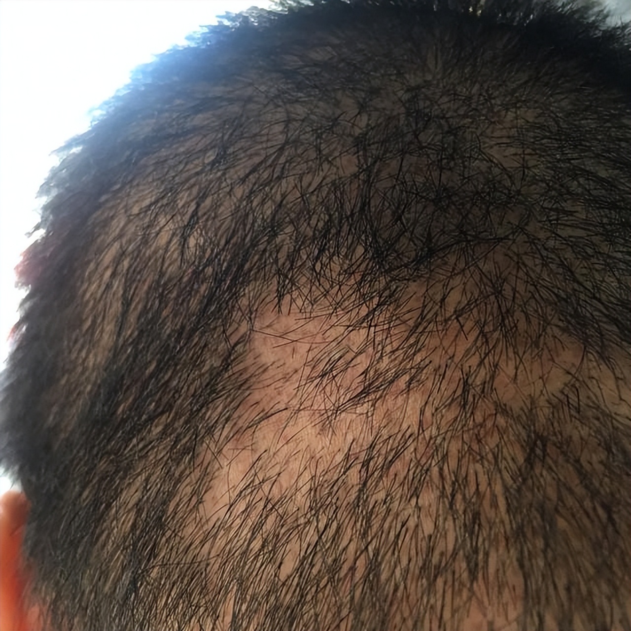 头皮总长疙瘩和脓包是怎么回事,头皮老是长疙瘩有脓包怎么办