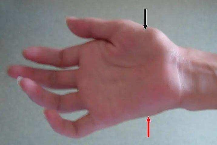 手萎缩无力是什么病,手腕无力手指笨拙虎口萎缩