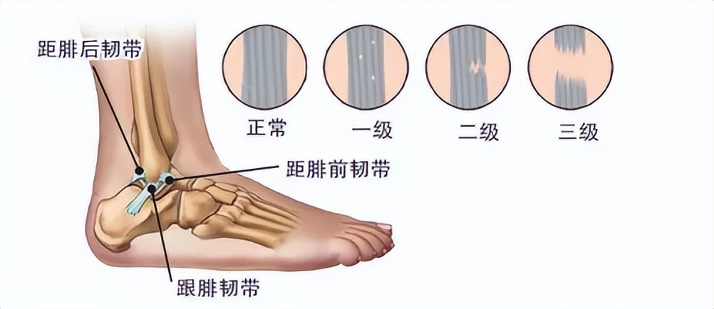 脚踝扭伤的处理方法和康复,脚踝扭伤立即进行的正确处理方法
