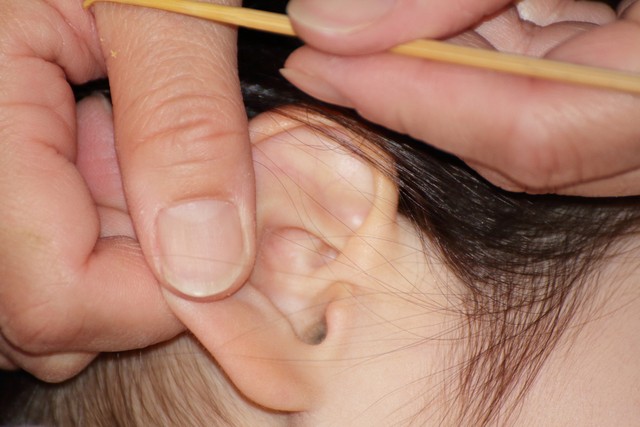 6岁儿子耳朵取出来好多耳屎,小孩耳朵里掏出很多褐色耳屎