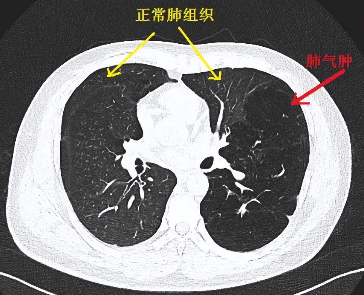 肺气肿病因,肺炎肺气肿