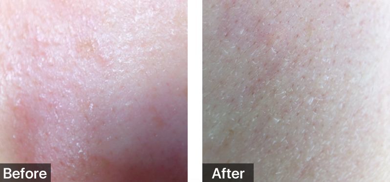 脸上起皮了是怎么回事,脸上起皮是什么原因怎么办