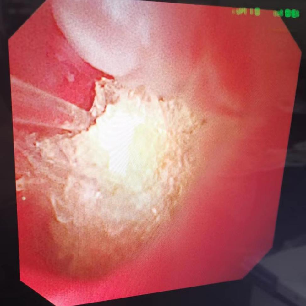 让结石无处藏身：北京老年医院泌尿外科成功实施老龄高危患者一期双侧输尿管软镜钬激光碎石取石术