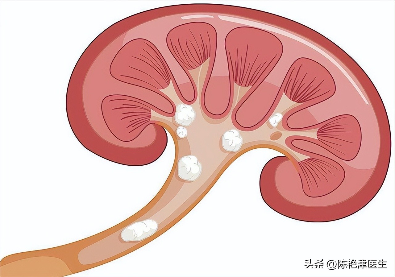 体检查出肾结石怎么办？医生：2个方法，或能让肾结石离开身体