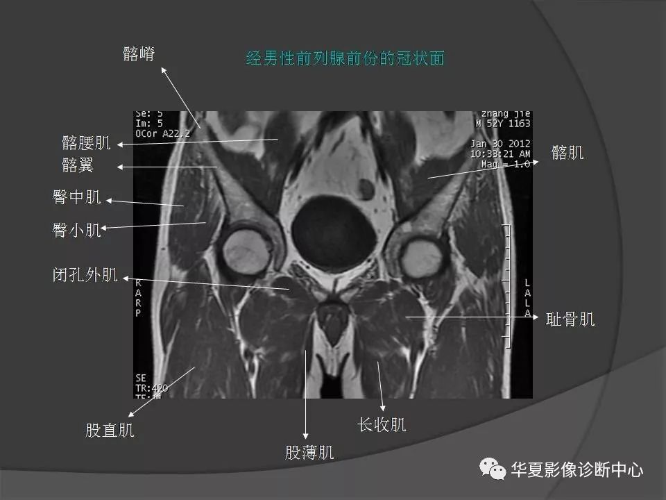 女性盆腔ct连续断层解剖图,盆腔mri影像病例分析