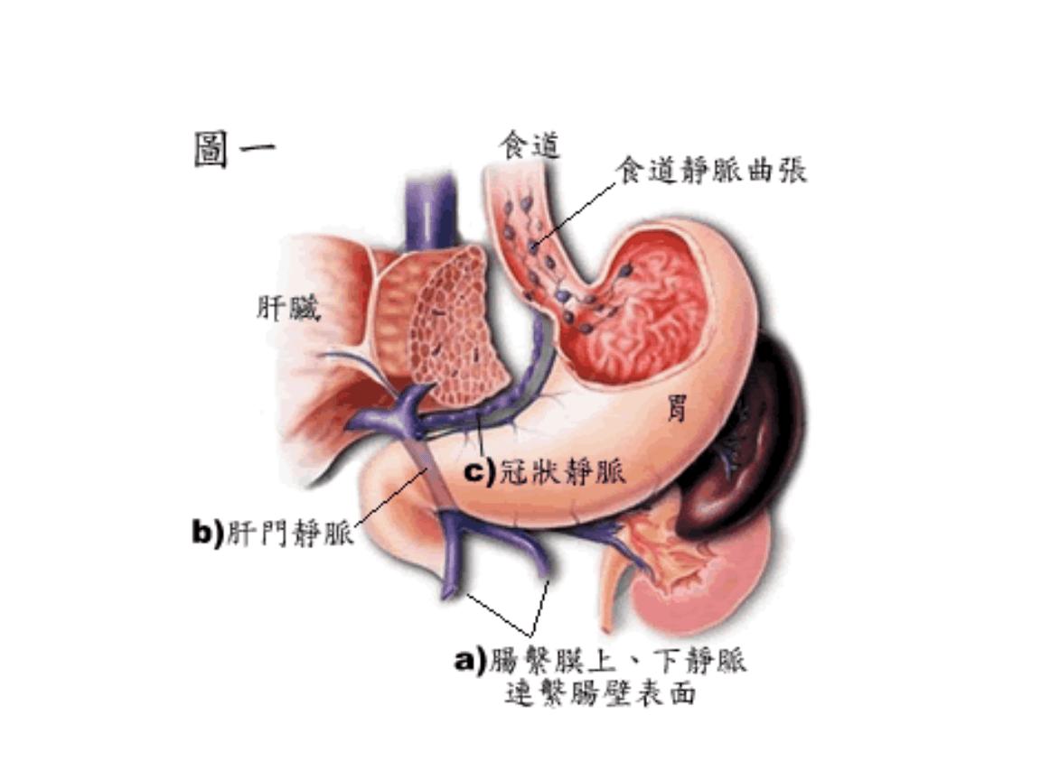 生气会引起胃出血,食管静脉曲张是呕血还是排黑便