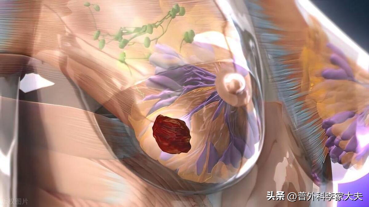 乳腺癌治疗突破性新药,乳腺癌her2阳性靶向药