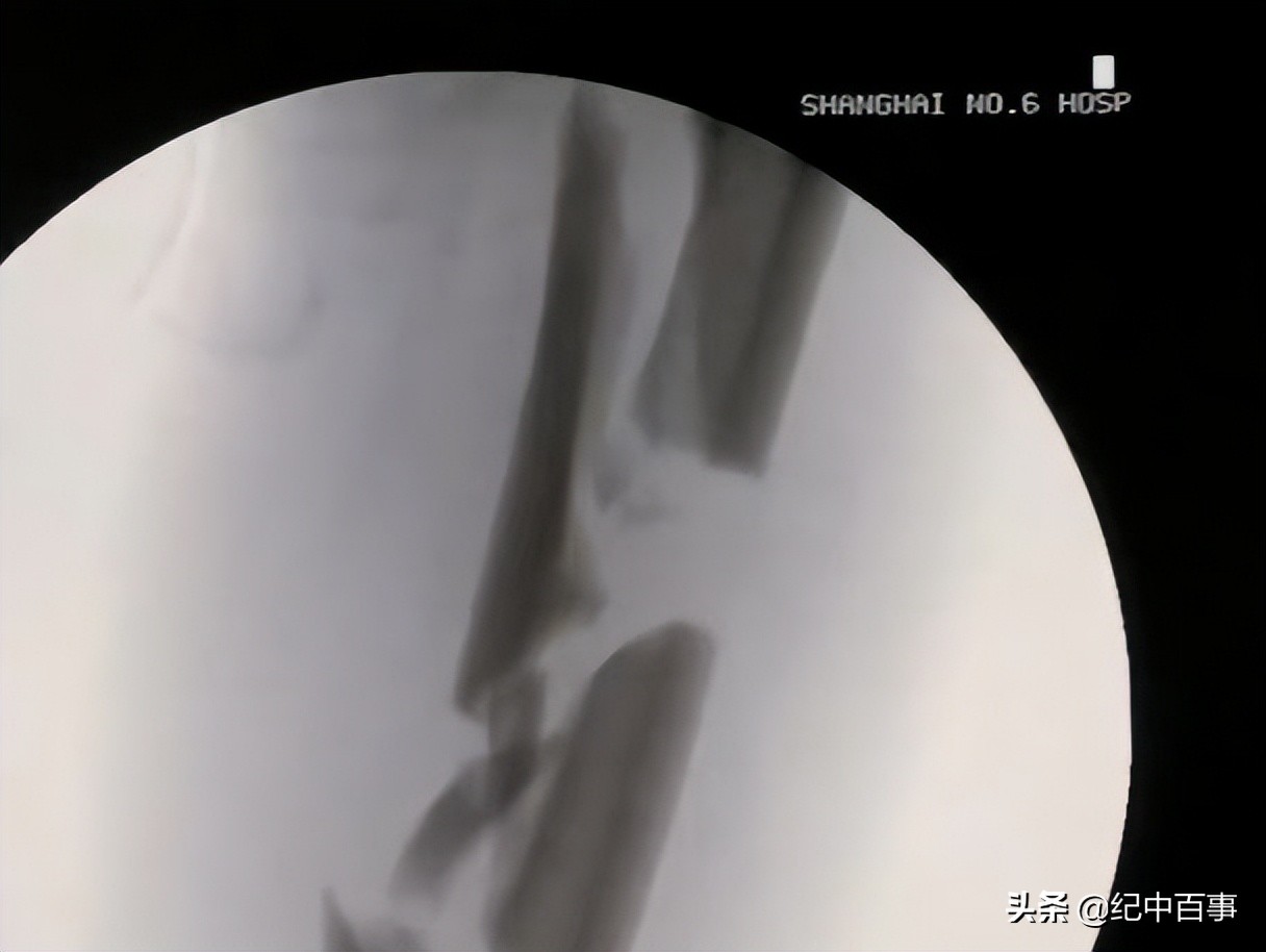 男子提着断腿去医院,上海男子抢救室内放弃治疗