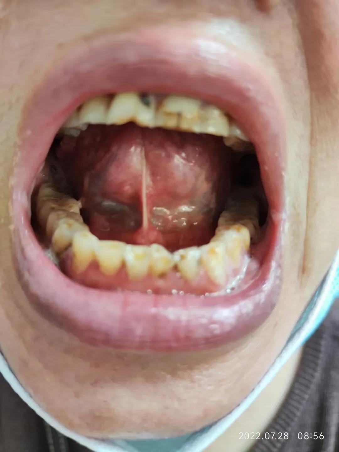 干燥综合征吃中药多久可以控制,干燥综合征喝中药可以治愈吗