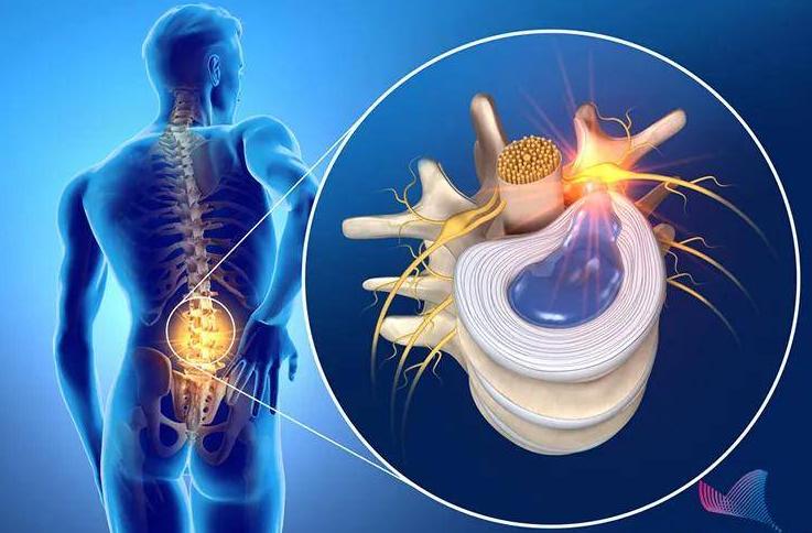 腰椎间盘突出是什么原因引起的,腰椎间盘突出症状表现3d动画