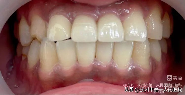 种植牙可修复多种牙齿缺失类型,学科建设口腔科