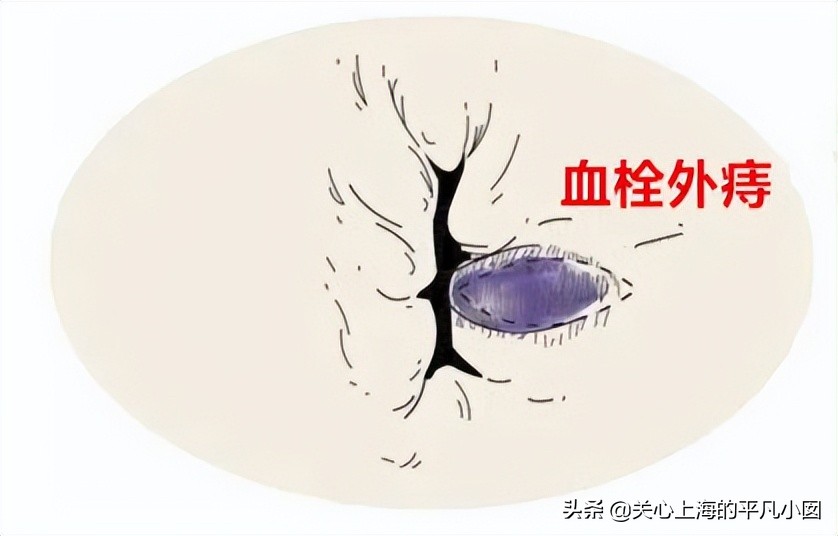 痔疮肛门痛用什么药,肛门瘙痒痛是痔疮吗